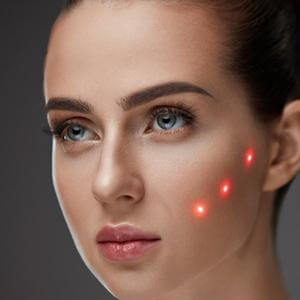 laser-frakcyjny-wiazki lasera na twarzy